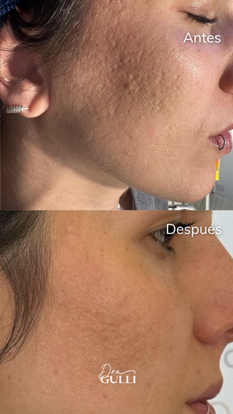 Rosacea 
