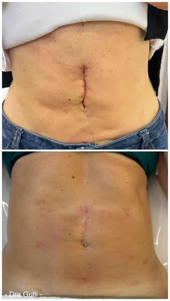 Rosacea 