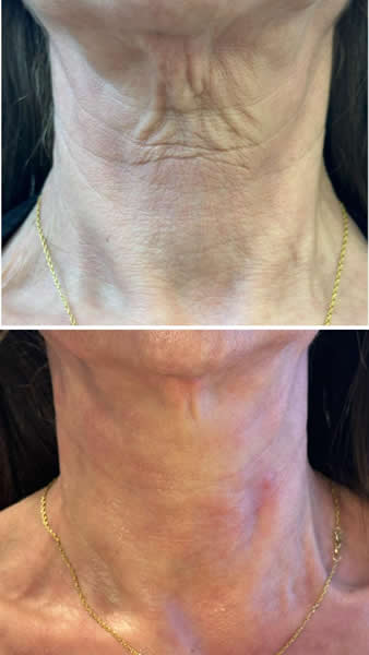 Rosacea 