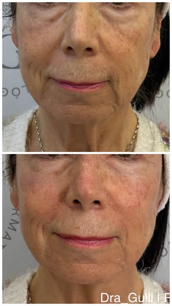 Rosacea 