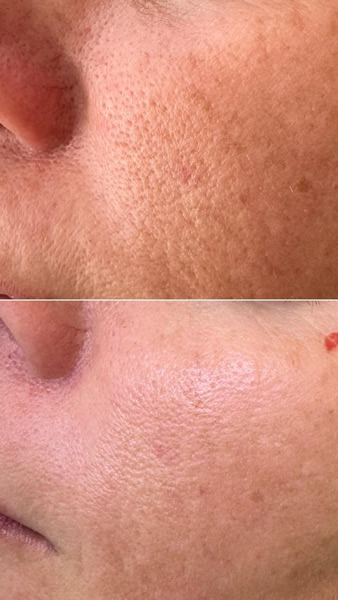 Rosacea 